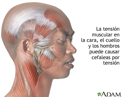 ¿Qué es la cefalea tensional? Tu Fisioterapeuta a domicilio en Alicante para el dolor de cabeza.