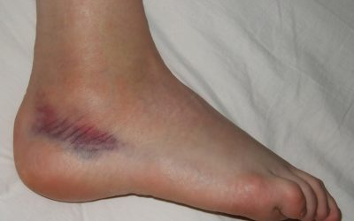 Esguince de tobillo. Análisis Soul Fisioterapia a Domicilio