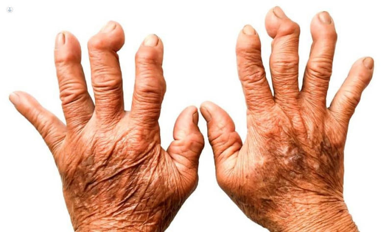 Artritis reumatoide