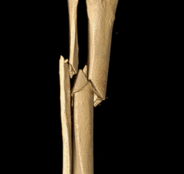 Fractura de tibia y peroné: Un desafío para la recuperación ósea y funcional