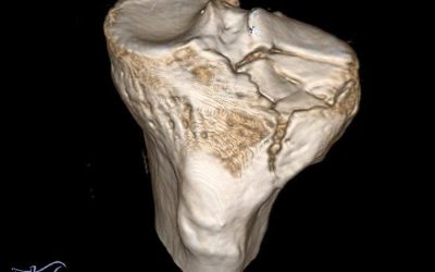 Fractura de meseta tibial