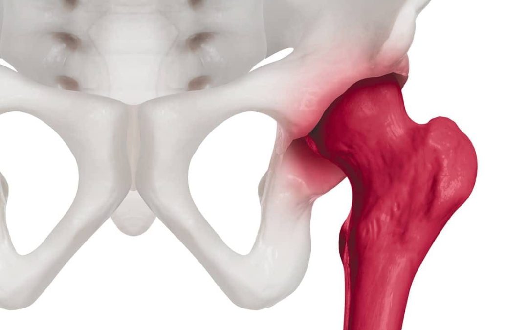 Superando los desafíos de la artrosis de cadera ¡Recupera tu movilidad y calidad de vida!