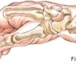 fractura de colles