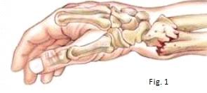 Fractura de Colles: Una lesión común en la muñeca que requiere atención médica