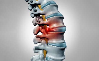 Hernia discal: causas, síntomas, diagnóstico y opciones de tratamiento