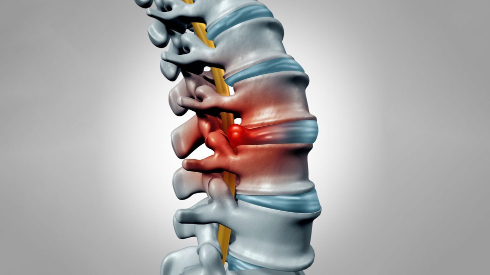 hernia discal