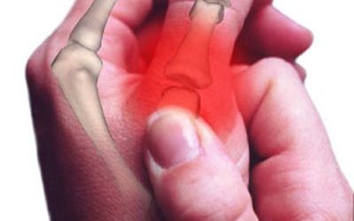 Rizartrosis: una afección dolorosa que afecta el pulgar