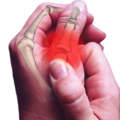 Rizartrosis: una afección dolorosa que afecta el pulgar